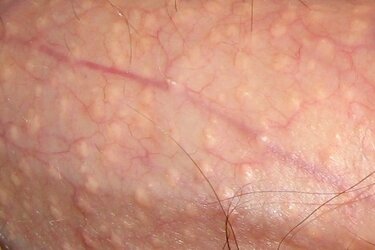 6-dấu-hiệu-mụn-nhọn-nổi-ở-dương-vật-gây-nguy-hiểm-5.jpg